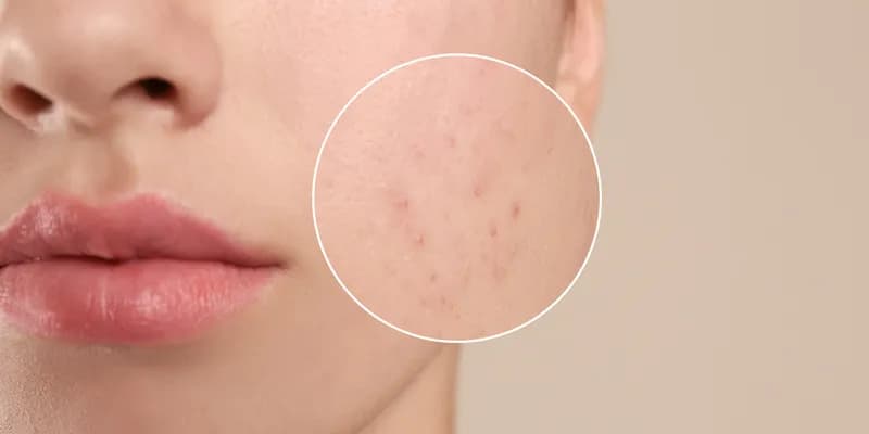 Podskórny pryszcz: Przyspiesz dojrzewanie i uniknij blizn!