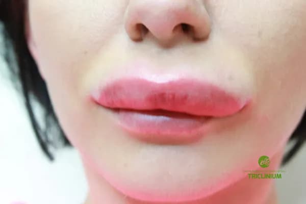 Jak zmniejszyć obrzęk po powiększaniu ust? Sprawdzone metody