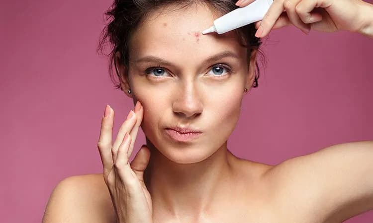 Szybka walka z pryszczami: sprawdzone metody i czego unikać?