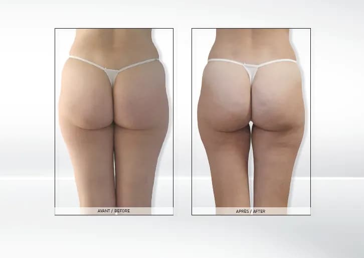 Endermologia: czy warto? Opinie z forum, koszty i efekty (70 znaków)