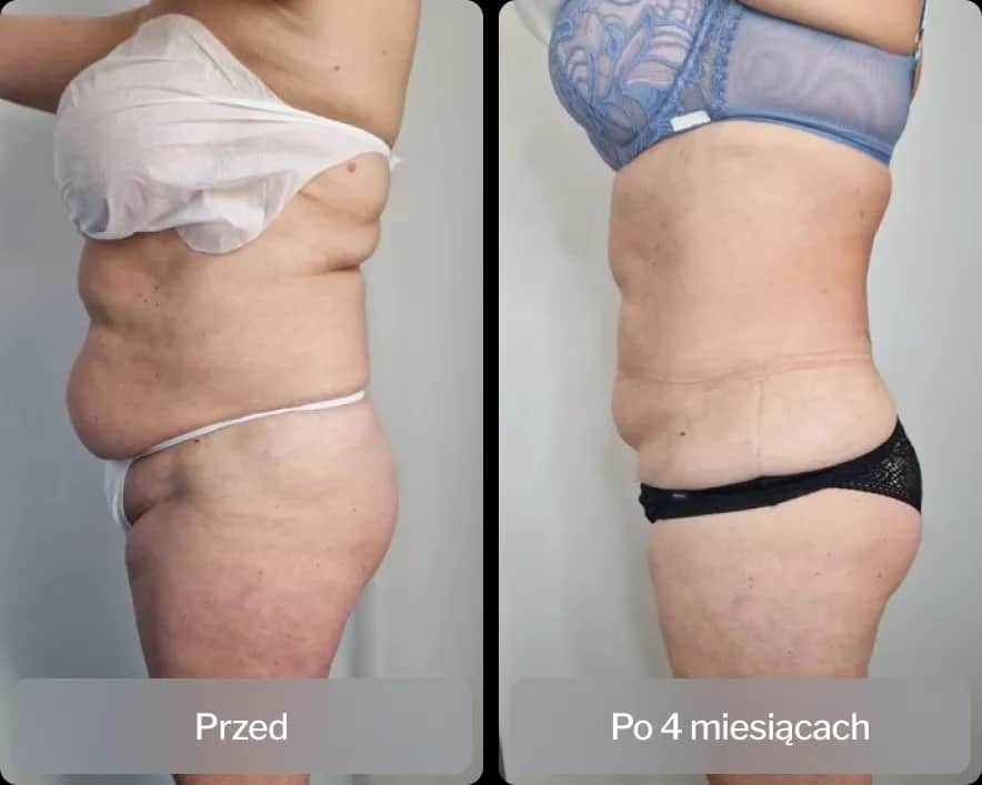 Liposukcja: Co to jest? Pełny przewodnik po zabiegu.