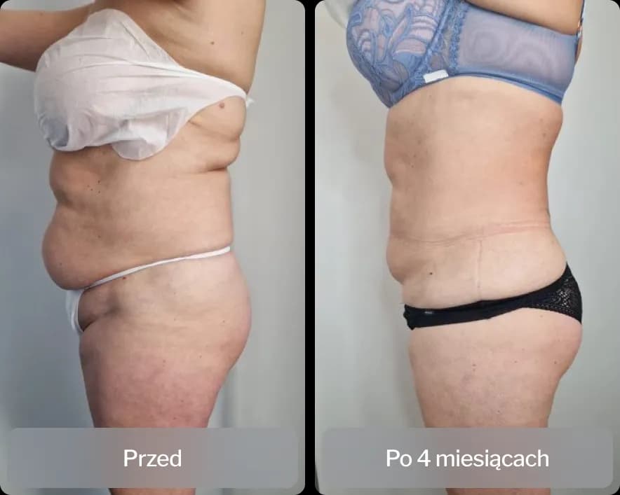 Liposukcja: Co to jest? Pełny przewodnik po zabiegu.