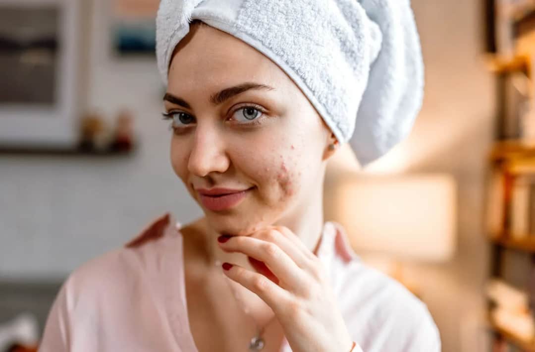 Jak pozbyć się pryszczy? Skuteczne metody i błędy w pielęgnacji