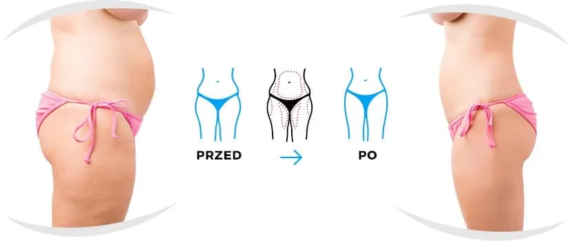 Liposukcja: Czy jest bezpieczna? Dowiedz się, zanim podejmiesz decyzję