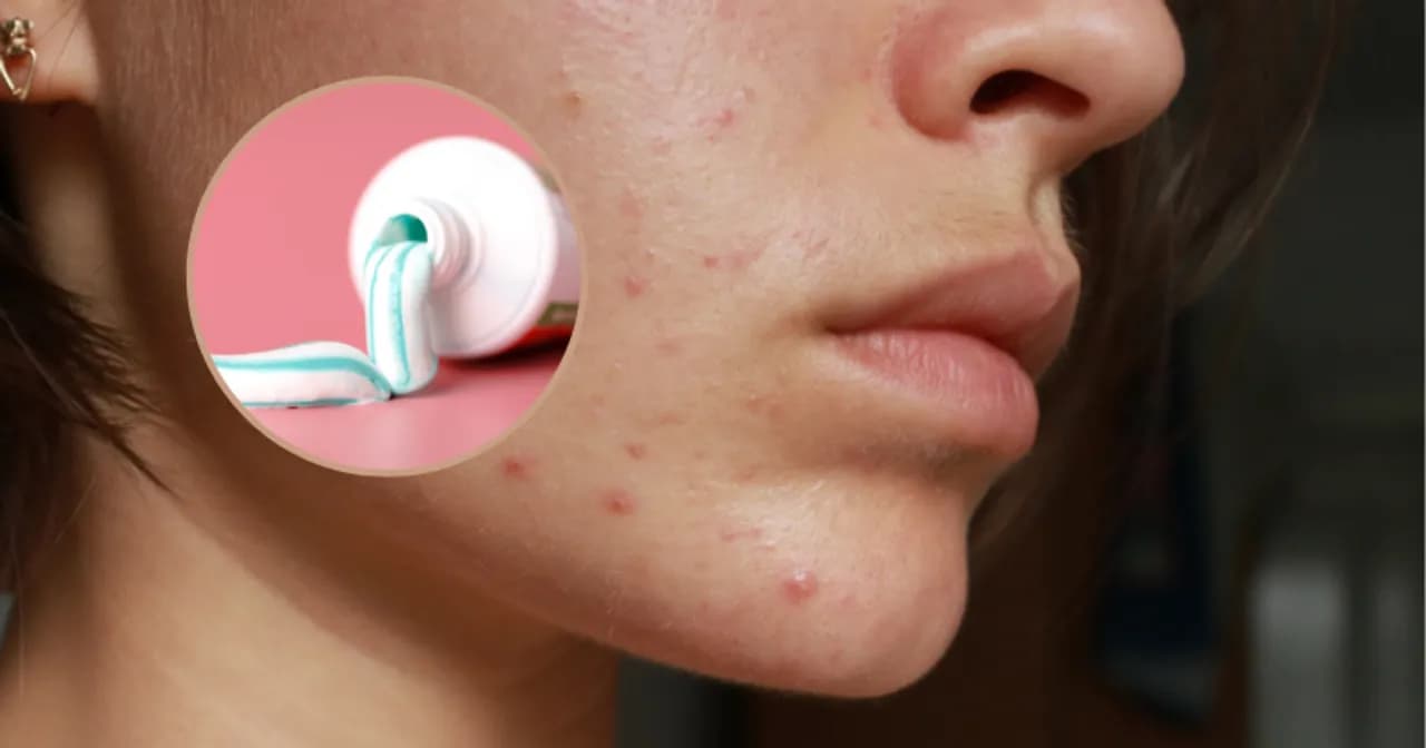Pasta do zębów na pryszcze? Mit! Odkryj bezpieczne alternatywy