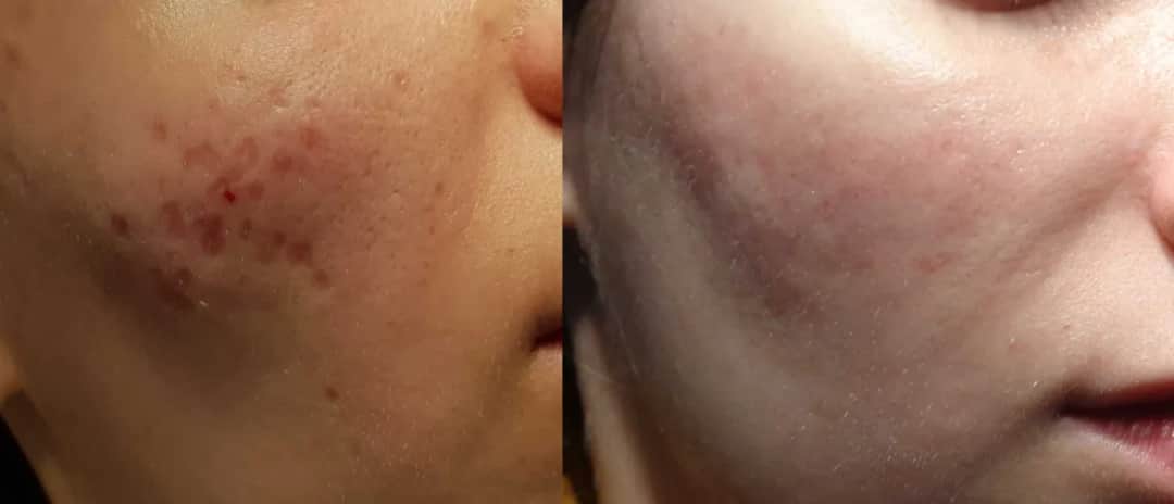 Jak usunąć blizny po trądziku? Pełny przewodnik i sprawdzone metody