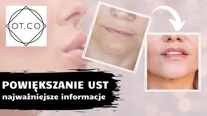 Powiększanie ust: Bezpieczeństwo, efekty, koszty wszystko, co musisz wiedzieć