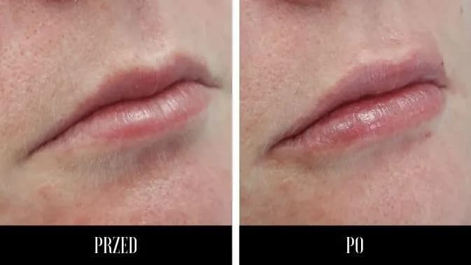 Kwas hialuronowy do ust: Jak wybrać idealny dla naturalnego wyglądu?