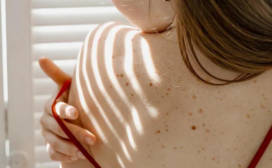 Jak pozbyć się pryszczy na plecach (bacne)? Kompletny przewodnik