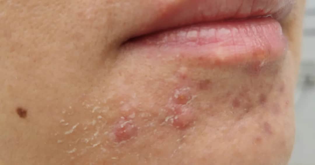 Pryszcze na twarzy: Jak się pozbyć? Skuteczny poradnik ekspertki
