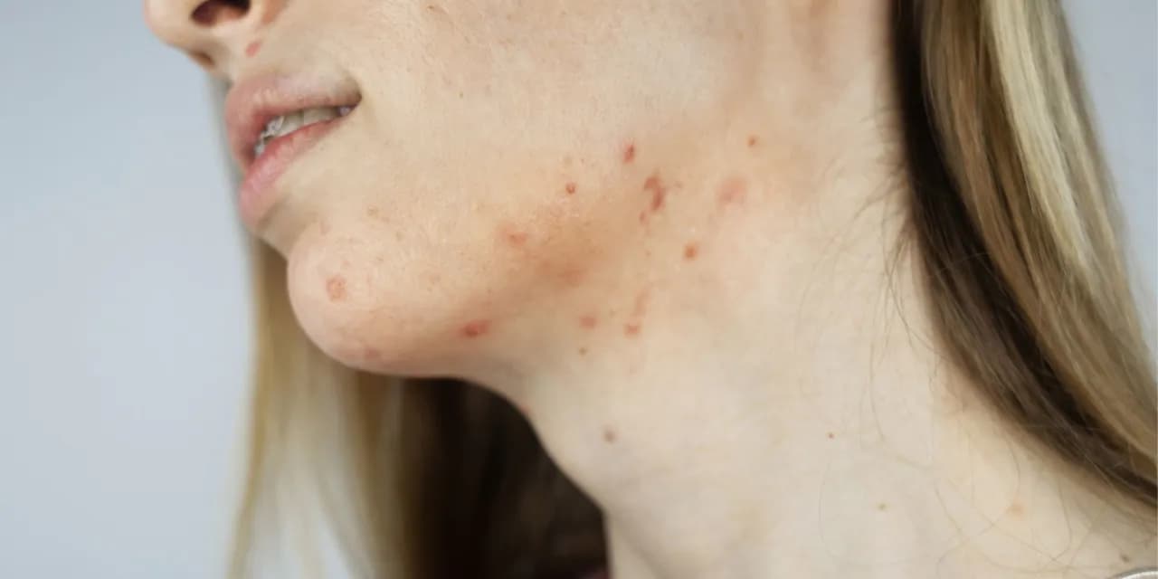 Pryszcze na brodzie: Co sygnalizują hormony i jak się ich pozbyć?