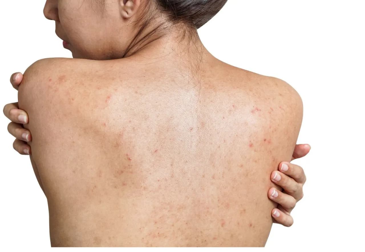 Pryszcze na plecach? Skuteczny poradnik: przyczyny, pielęgnacja, leczenie