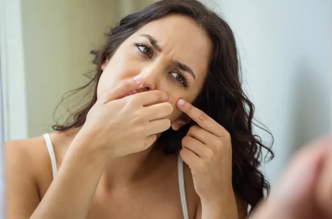 Kiedy wyciskać pryszcze? Poradnik eksperta, by uniknąć blizn