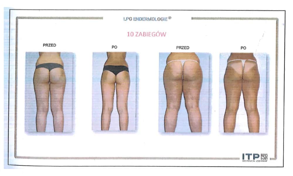 Endermologia: Czy warto inwestować? Efekty, koszty, wady