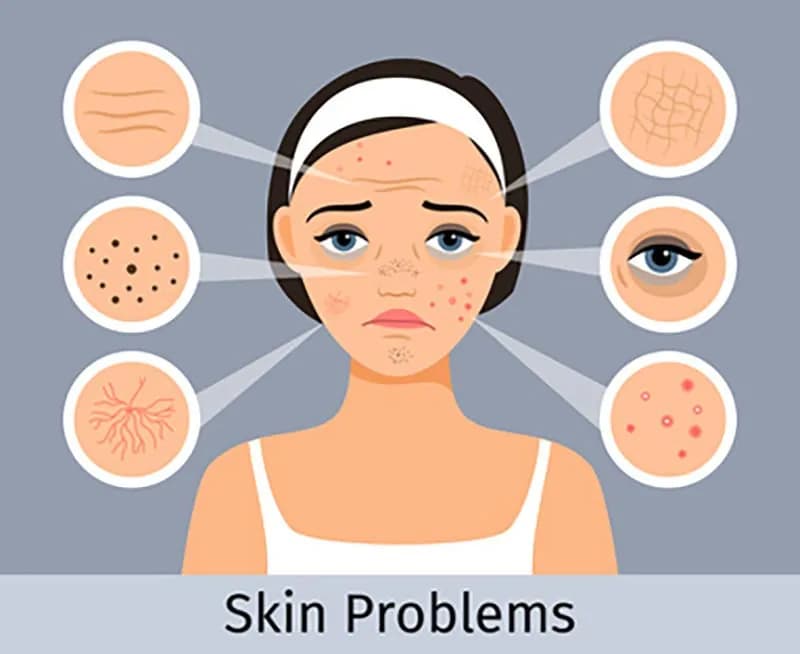 Jak pozbyć się śladów po pryszczach? Kompleksowy przewodnik