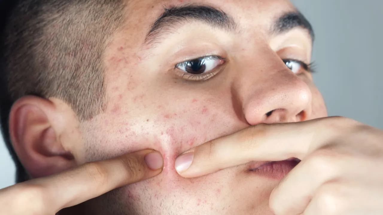 Jak zlikwidować pryszcze? Szybkie triki i trwała pielęgnacja