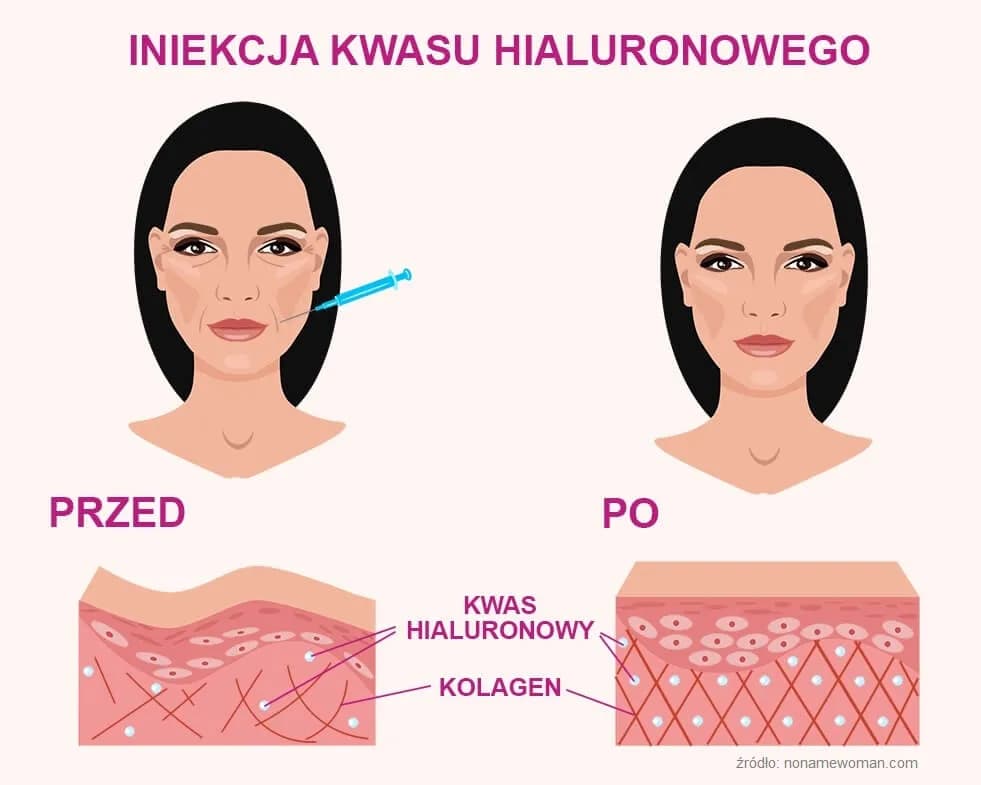 Co daje kwas hialuronowy? Odkryj pełnię korzyści dla skóry!